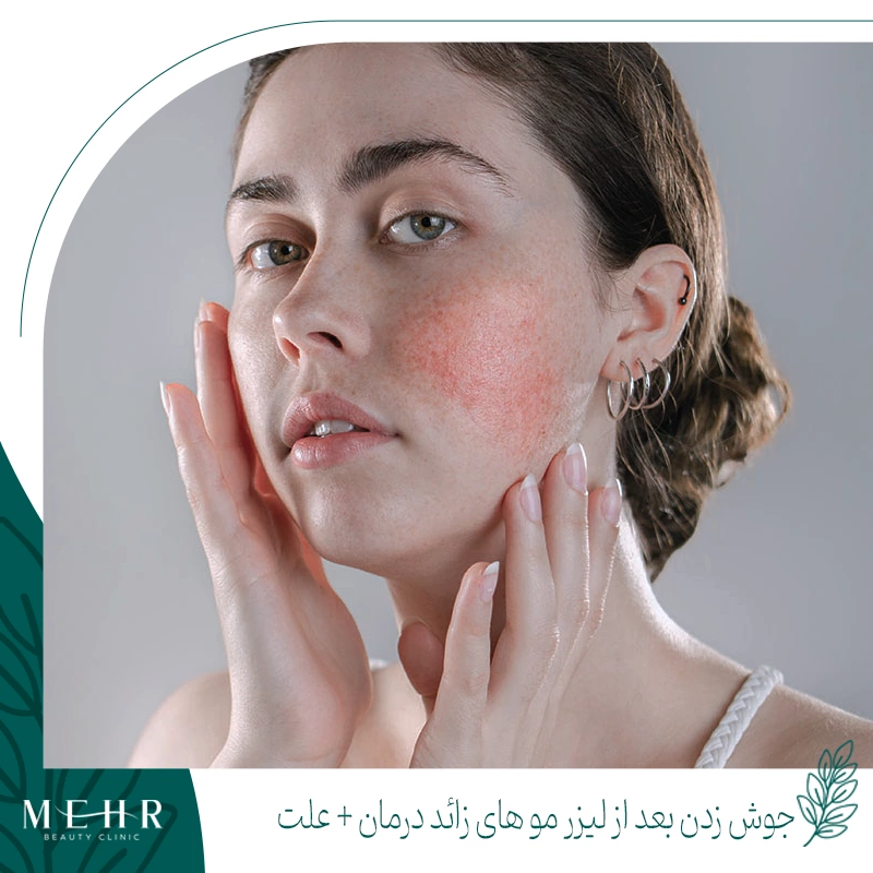 درمان جوش بعد از لیزر صورت کلینیک لیزر مهر شیراز